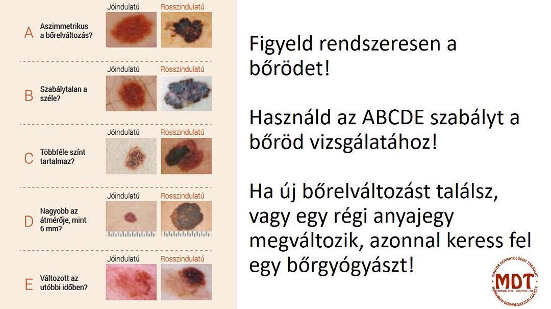 Thomy® Folia, melanoma, UV védelem, bababarát fólia, kisállatbarát fólia, szolárium