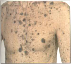 Thomy® Folia, melanoma, UV védelem, bababarát fólia, kisállatbarát fólia, szolárium