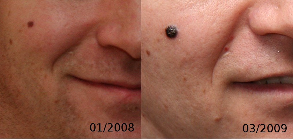 Thomy® Folia, melanoma, UV védelem, bababarát fólia, kisállatbarát fólia, szolárium